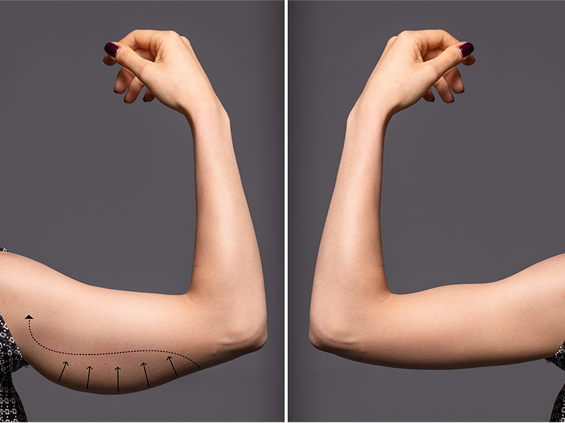 Arm Lift (Arm Reduction) 2 Arm Lift (Arm Reduction)