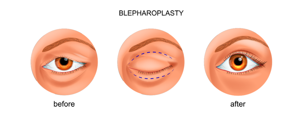 Blepharoplasty Eyelid Reduction 2