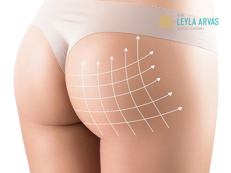 Buttock Lift - Achieve the Perfect Shape for Your Rear