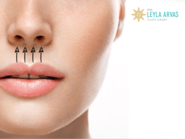 Lip Lift 1 Lip Lift