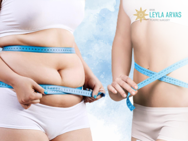 Liposuction İle Kaç Kilo Yağ Alınır