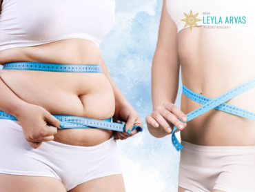 What is the Maximum Fat Removal with Liposuction? 1 Liposuction İle Kaç Kilo Yağ Alınır
