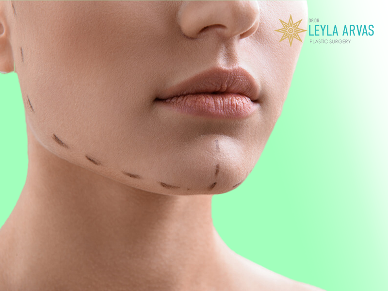 Chin Augmentation (Chin Implants) 2 cene implanti dr leyla arvas