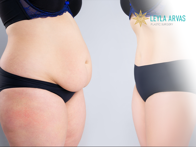 Liposuction 2 Liposuction