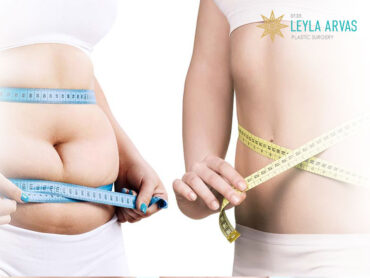 Regional Weight Loss 1 Bölgesel Zayıflama