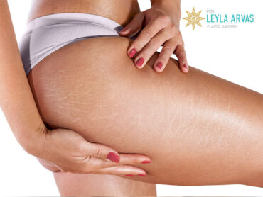 Stretch Mark Treatment 1 Çatlak Tedavisi