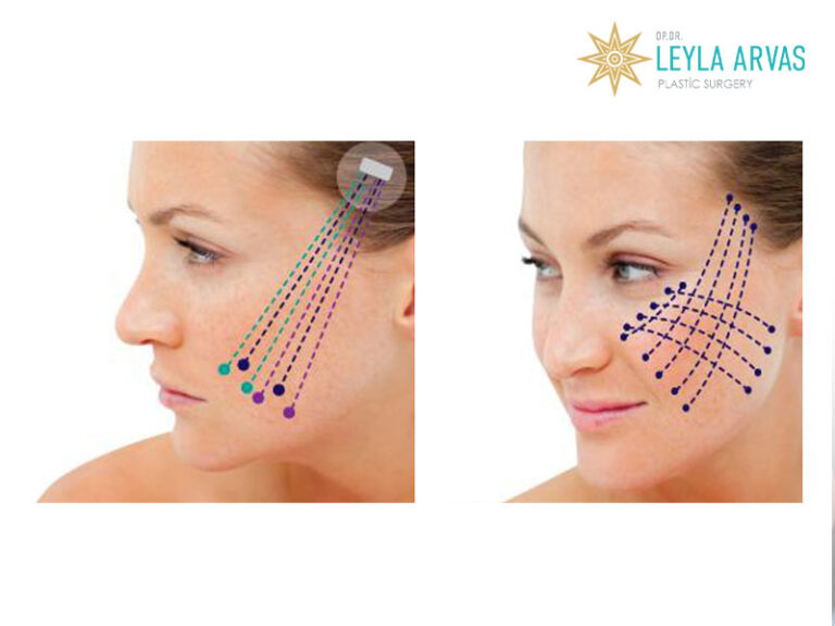 Deep Thread Lift - Lift & Tighten Your Skin - Op. Dr. Leyla