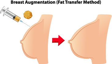 Fat Transfer To Breast