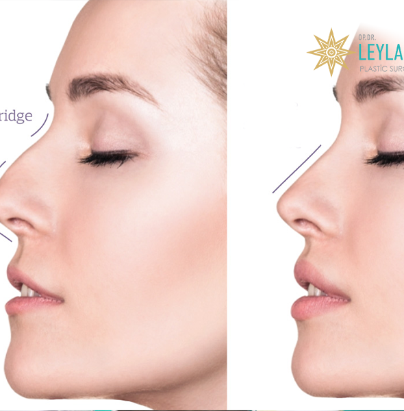 Nose Tip Lift