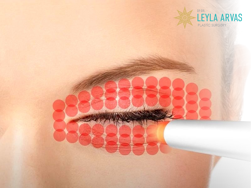 Smooth Eye (Non-Surgical Eyelid Procedure) 2 Smooth Eye (Non-Surgical Eyelid Procedure)