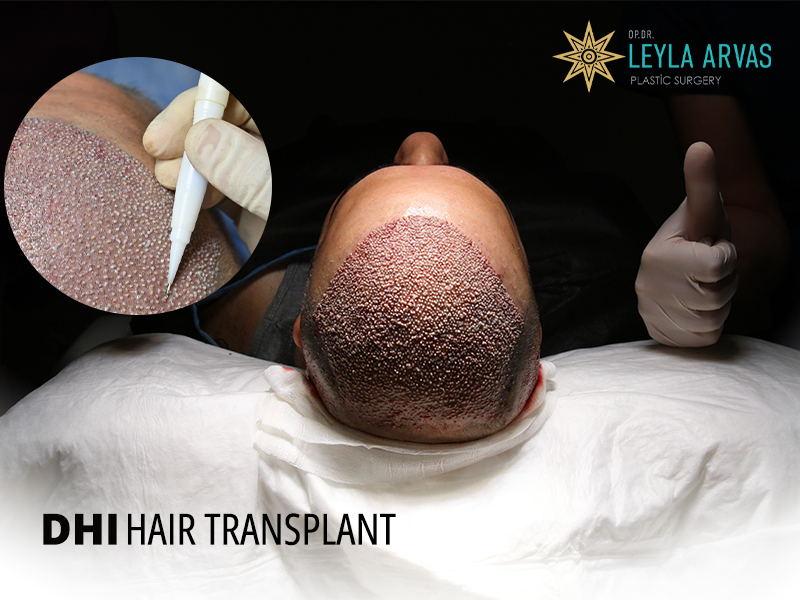 DHI Hair Transplant 2 dhi hair transplant