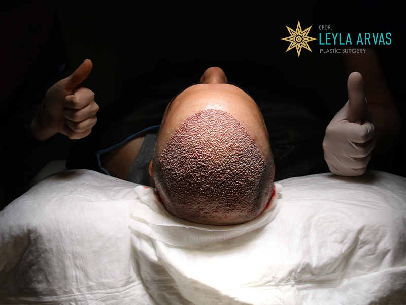 Hair Transplant 2 hair transplant