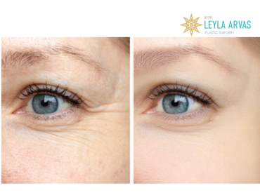Wrinkle Treatment 1 kırısıklık tedavisi