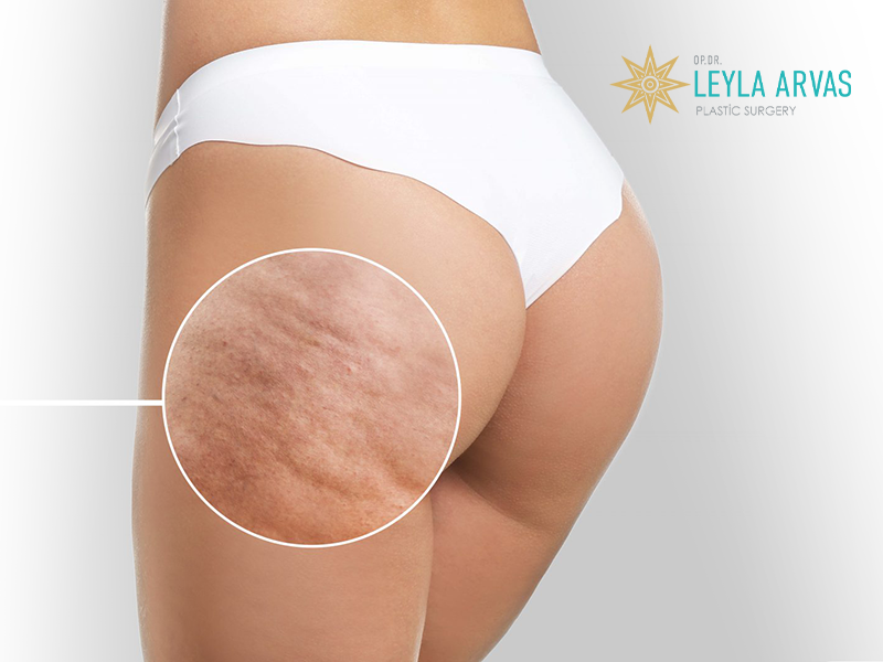 Cellulite Treatment 2 Cellulite Treatment