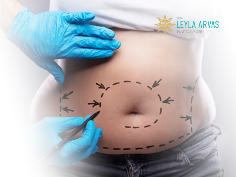 Liposuction (Liposakşın) 