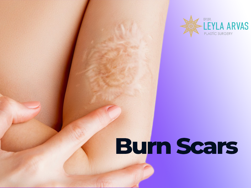 burn scars