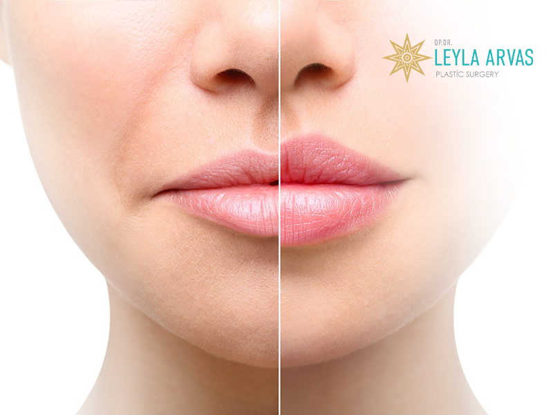 Lip Fillers 2 Lip fillers