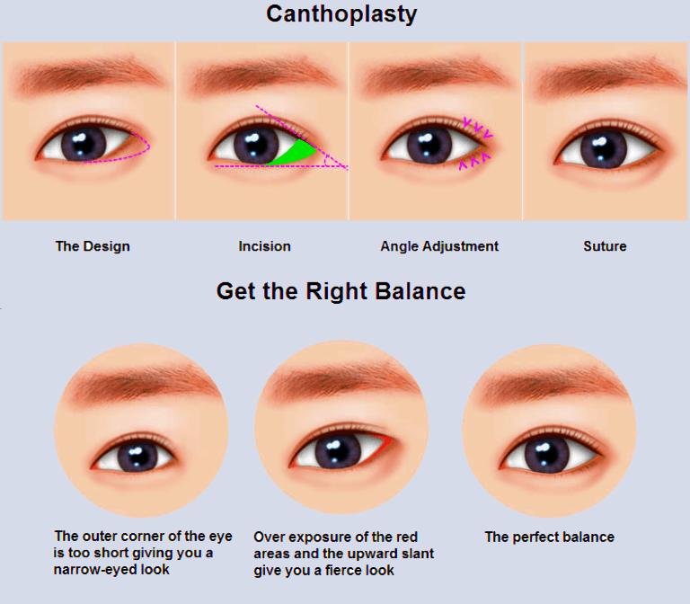 Canthoplasty 2 Canthoplasty