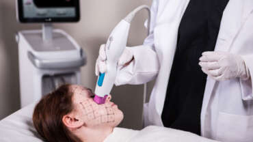 Thermage FLX 1 Thermage FLX™ drleylaarvas